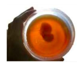 Brain Tumour Phantom