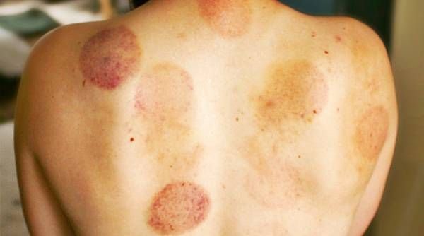 Cupping Therapy 01