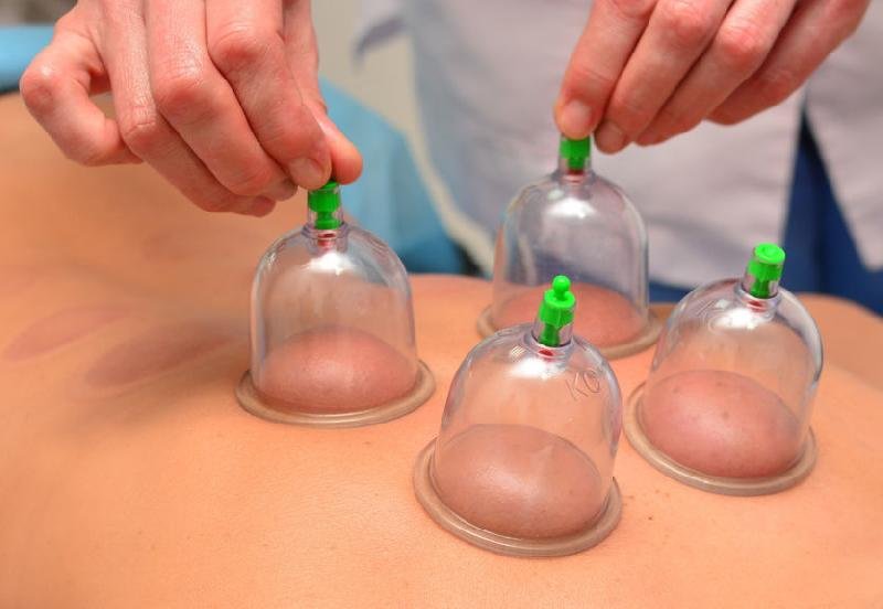 Cupping Therapy 03