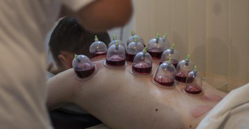 Hijama
