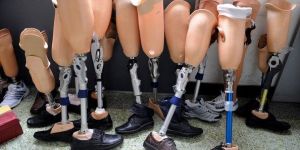 Artificial Limbs