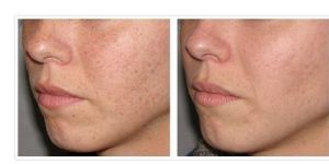 PIGMENTATION TREATMENT