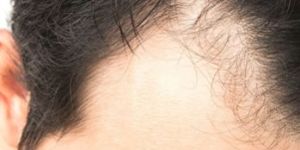 Alopecia Areata Treament