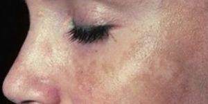 Discoloration Treatment