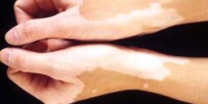Leucoderma Treatment