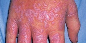Lichen Planus Treatment