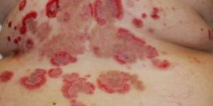 Pemphigus Vulgaris Treatment