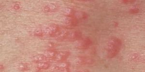 Scabies Treatment