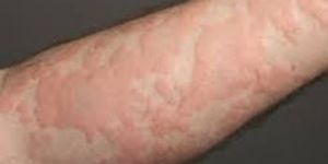 Urticaria Treatment