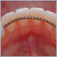 Bonded Retainer