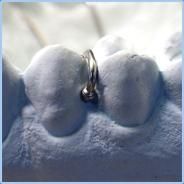 Ball Ended Dental Clasps