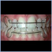 Dental Hawley Retainer