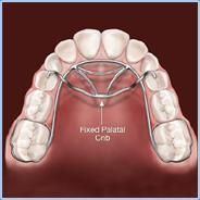 Thumb Sucking Habit Breaking Appliance Dental