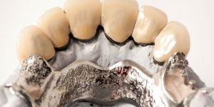 Cast Metal-Based Dentures