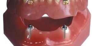 Telescopic Crowns