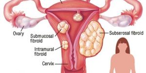 Fibroid Treatment