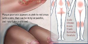 Psoriasis Chronic Skin Treatments