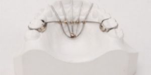 Fixed Habit Breaking Appliance