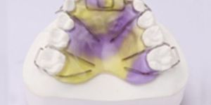 Removable Habit Breaking Appliance