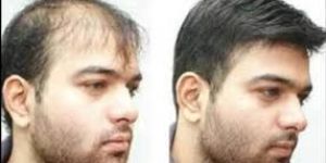 Hair Patching Services