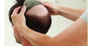 Non Surgical Hair Replacement