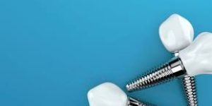 Dental Implant