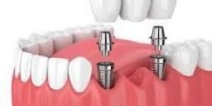 Dental Implants