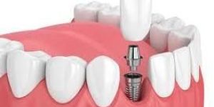 Dental Implants
