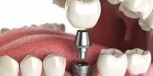 Dental Implants