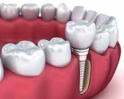 Dental Implants