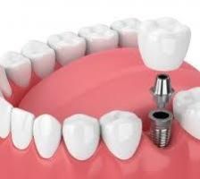 Dental Implants