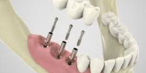 Dental Implants