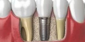 Dental Implants