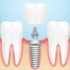 Dental Implants