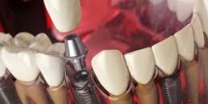 Dental Implants