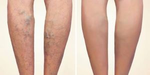 Varicose Vein Prevention Stocking