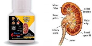 Kidney Stone Ayurvedic Medicine