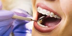 Orthodontic Treatments: Teeth Alignment