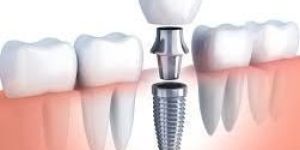 Replacement of Missing Teeth
