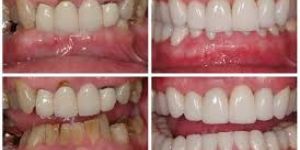 Restorative Treatments