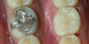 Cosmetic Fillings Treatment Services