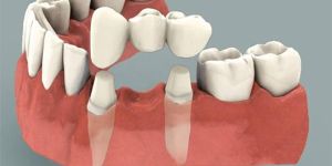 Crowns And Bridges Treatment Services