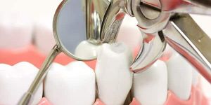 Tooth Extraction Treatment Services