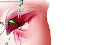 Lap. Gallbladder Stone Surgery