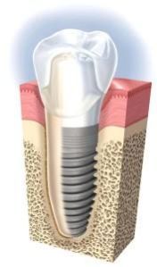 Dental Implants