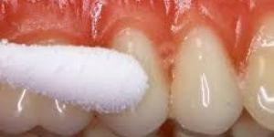 Bleeding Gums Treatment Services