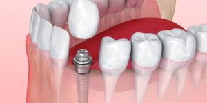Dental Implants