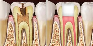 Root Canal Treatment