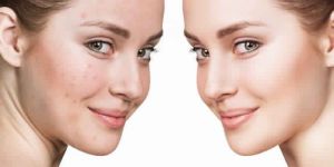 Acne Laser Treatment Services