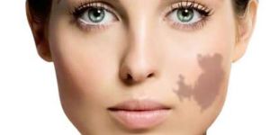 Tattoo Removal Treatment